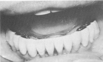1 Mandibular endosseous pin implant prosthesis placed