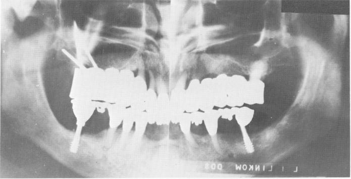 3 Panorex shows endosseous pin implants extending into zygomatic arch
