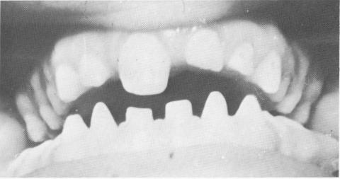 4 Case of almost complete anodontia of permanent teeth, pin consderation