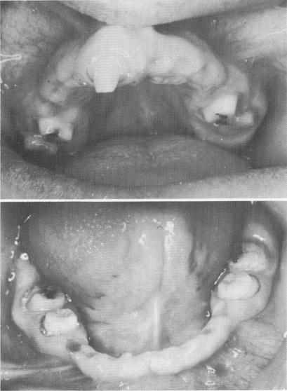 1 Upper central incisor,12 year molar prepared for full crown restoration