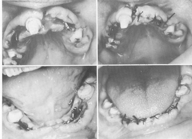 2 Two endosseous blade implants tapped into mandibular bone