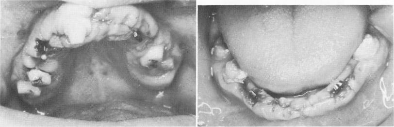 1 Postoperative view immediately after endosseous blade implantation