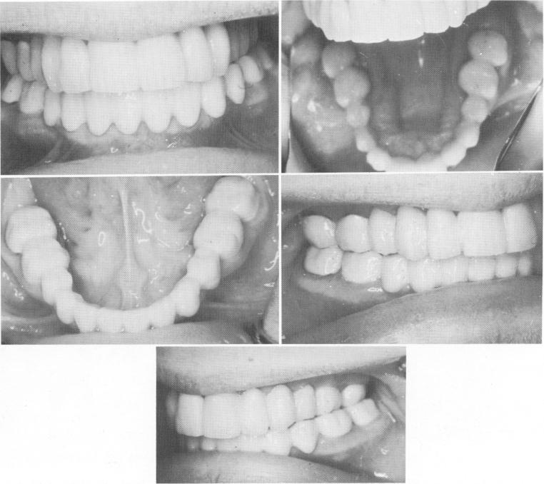2 Upper, lower full arch porcelain-fused-to-metal blade implant dentures