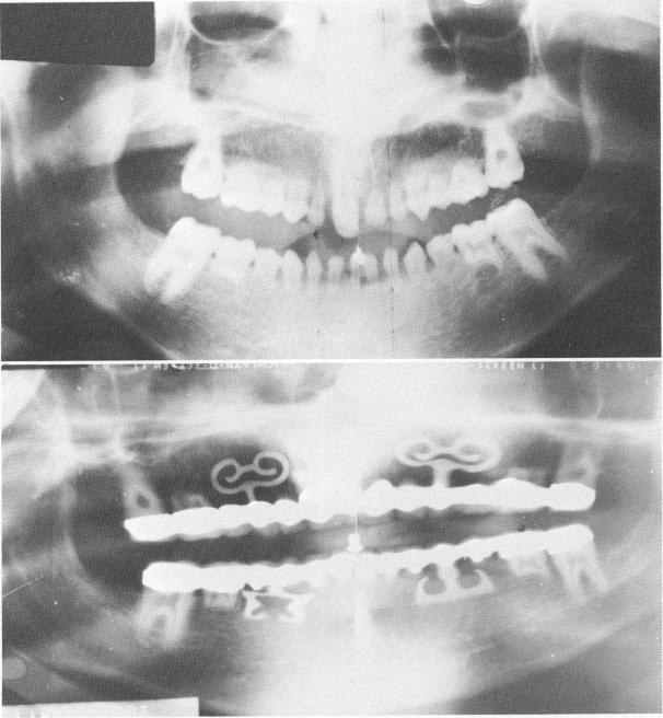 1 Panorex of completed case shows endosseous blade implants