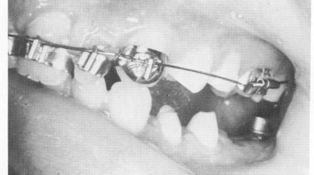 2 Endosseous  blade implant post protrudes through fibromucosal tissue