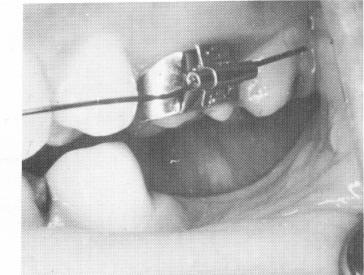 3 Lower edentulous area with upper arch wire,molar band with buccal tube