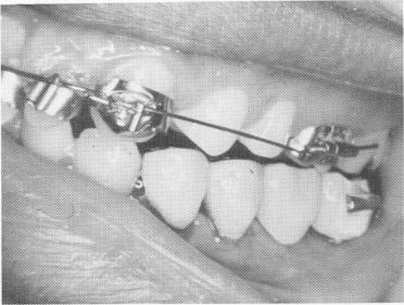 1 Four-unit bridge cemented on two bicuspid teeth and blade implant post