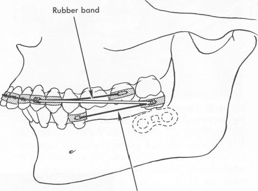 2 Rigid wire helps stabilize and splint blade implant to abutment tooth