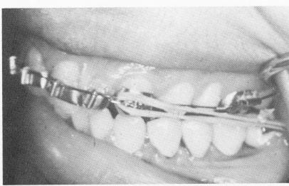 4 Distal movement of teeth using blade implant as intraoral anchorage 