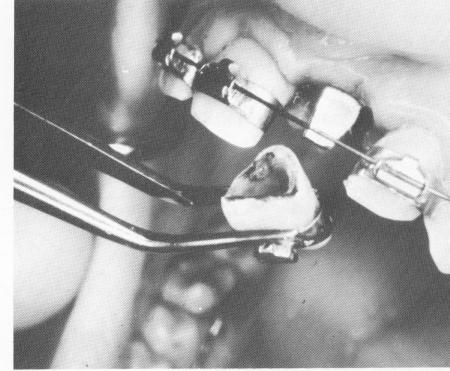 1 Tooth hollowed out to accept protruding blade implant post