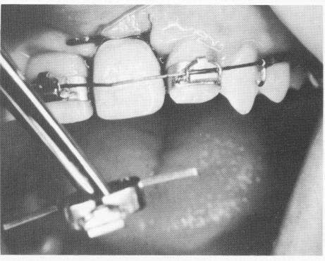 2 Band with labial bracket and lingual arms fitted to central incisor