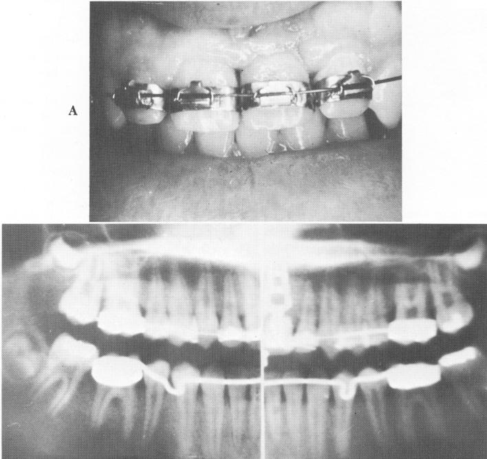 3 Tooth cemented over blade implant post and secured to arch wire