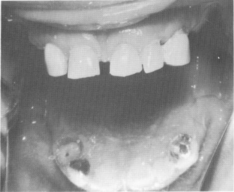 1 Upper arch with loose teeth and anterior diastema,implant intervention