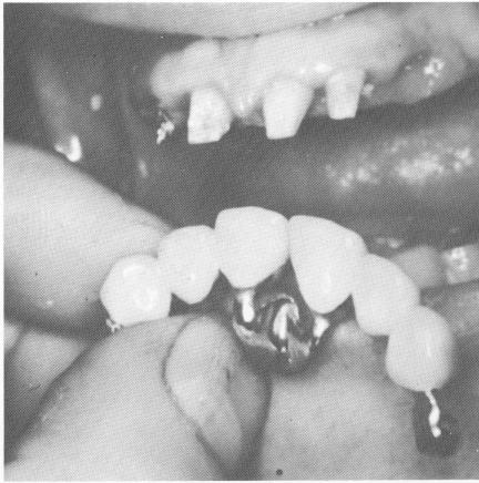 2 Anterior restoration, both quadrants joined by palatal plate