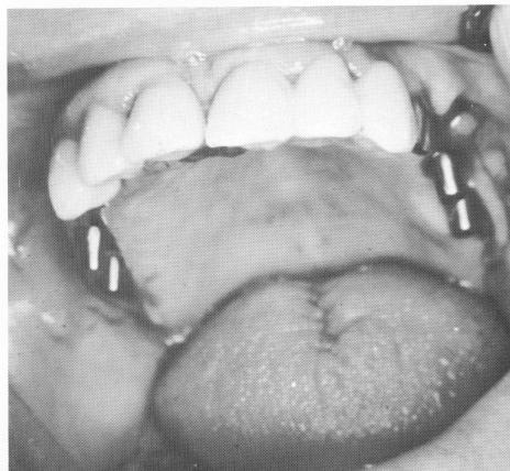 3 Endosseous blade implants set into two posterior edentulous areas
