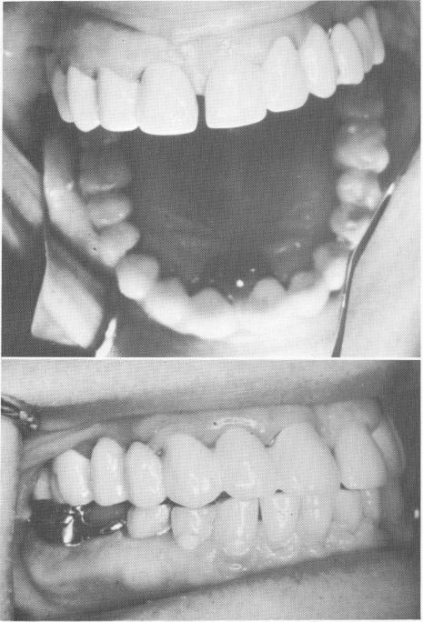 2 Three sections were cemented and the occlusion was carefully balanced