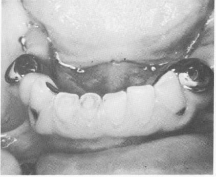 3 Wearing down of teeth from severe bruxism