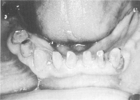 1 Blade implant placed posteriorly on each side of the mandible