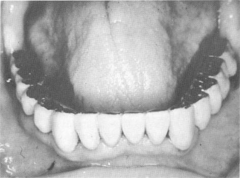 2 Full mandibular arch fixed implant prosthesis cemented in position