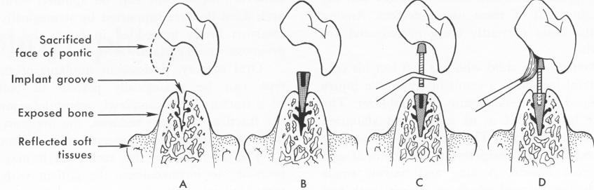 1 Groove prepared for placement of blade implant in mandible