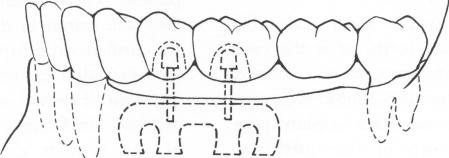 2 Double posted implant used as bridge stabilizer in mandible